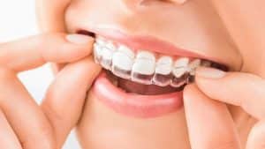 bruxismo clinica dental alcala de henares