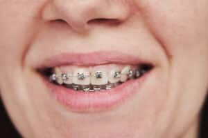 Ortodoncia en adultos