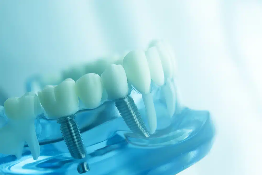 Implantes dentales en Alcalá de Henares