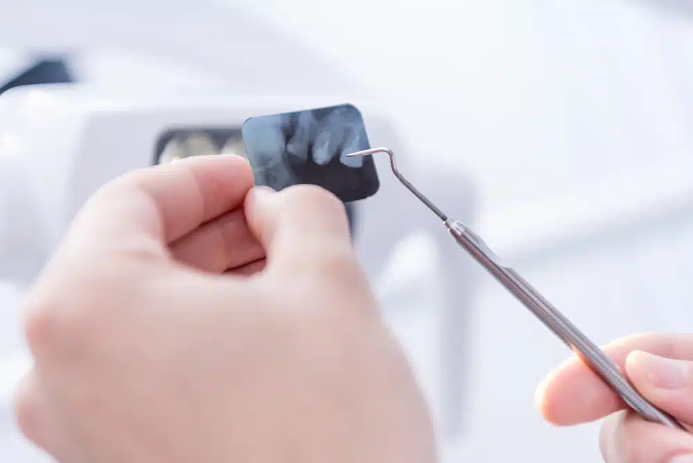 Endodoncia en Alcalá de Henares