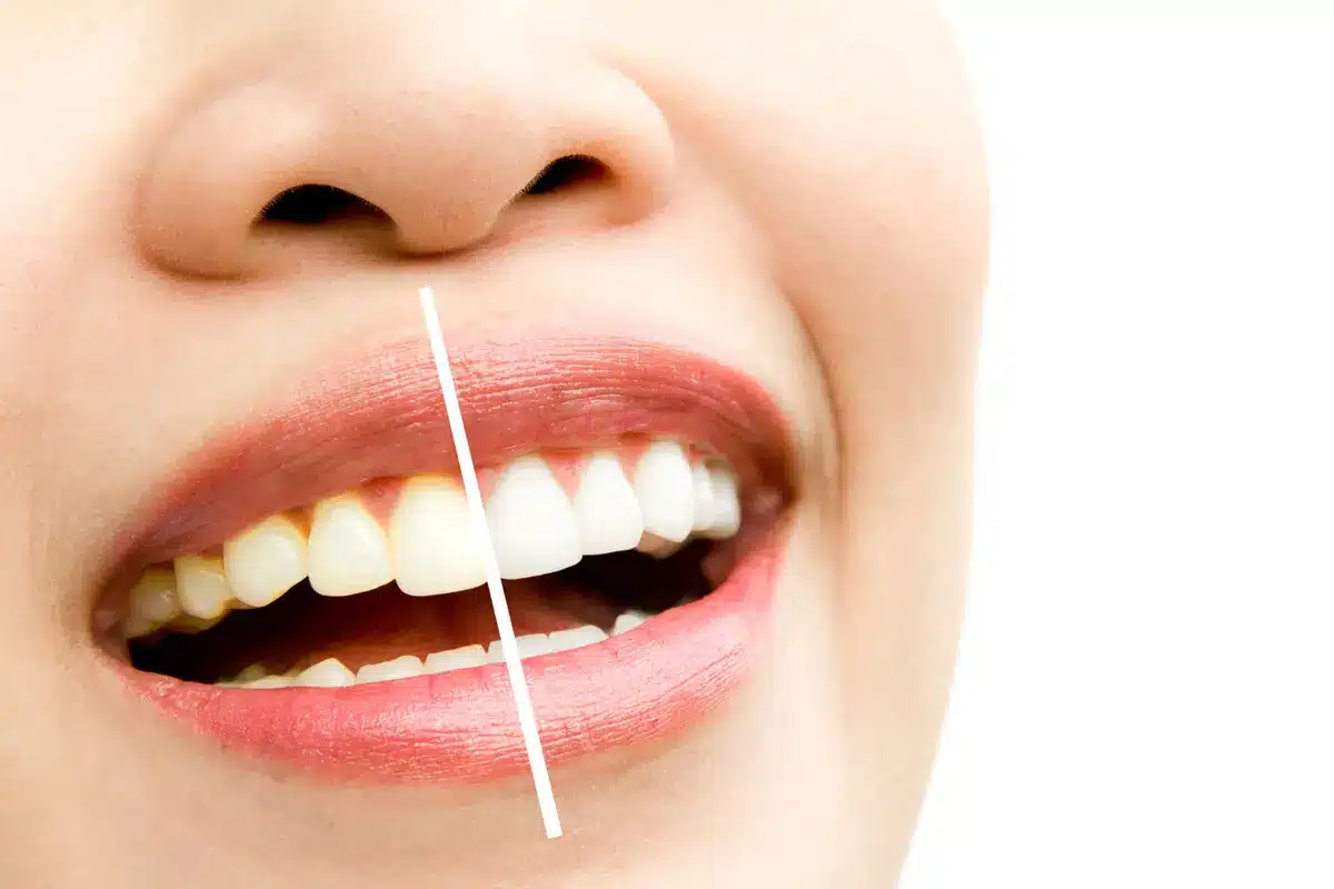 Blanqueamiento dental combinado con férulas