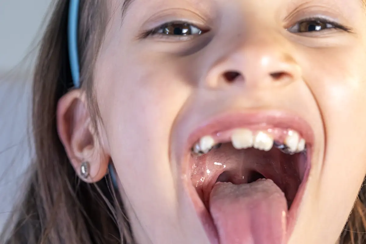 Revisión dental infantil de dientes de leche en Clínica DentoSmile Alcalá de Henares