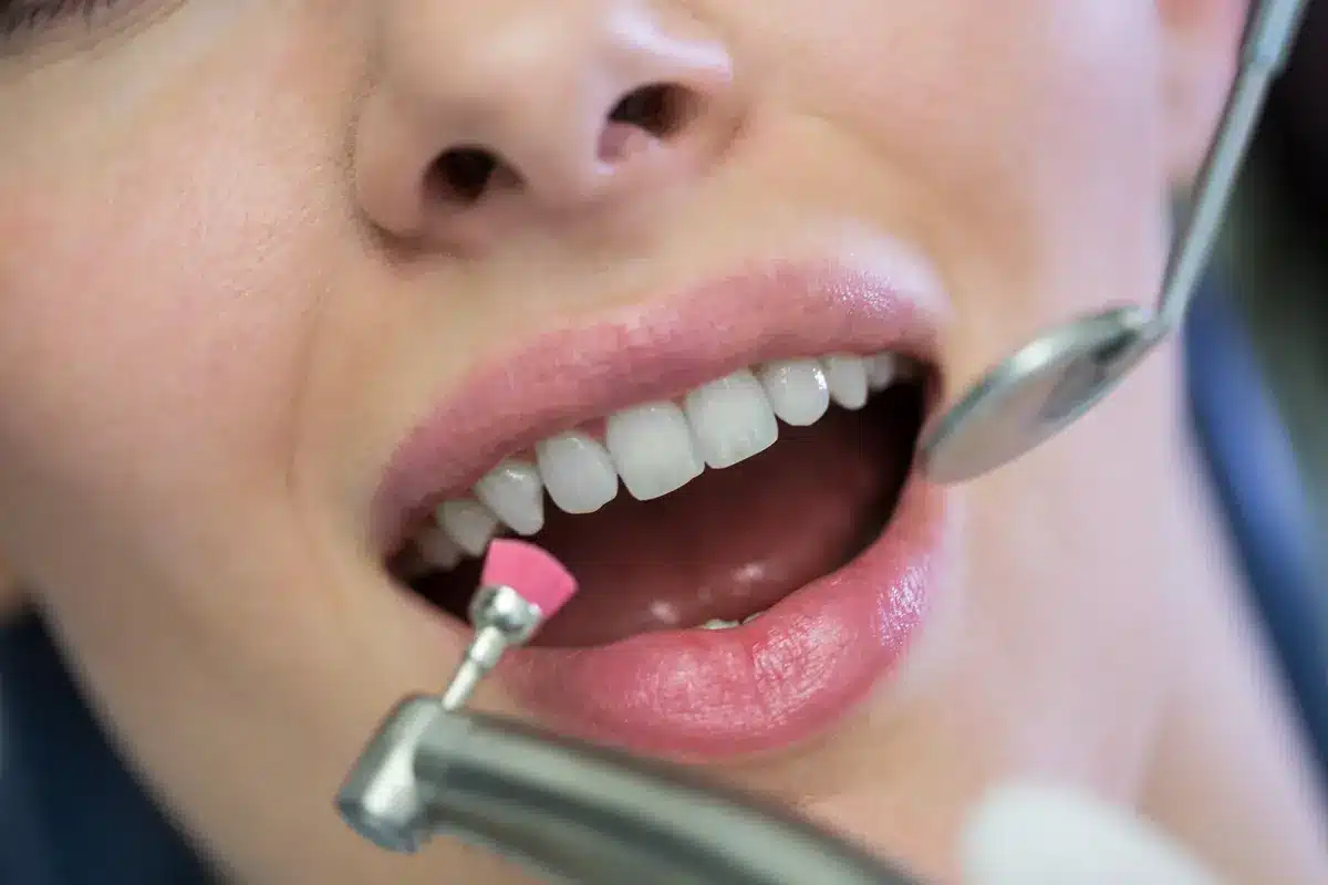 Pulido dental profesional durante una limpieza — resultado de dientes limpios