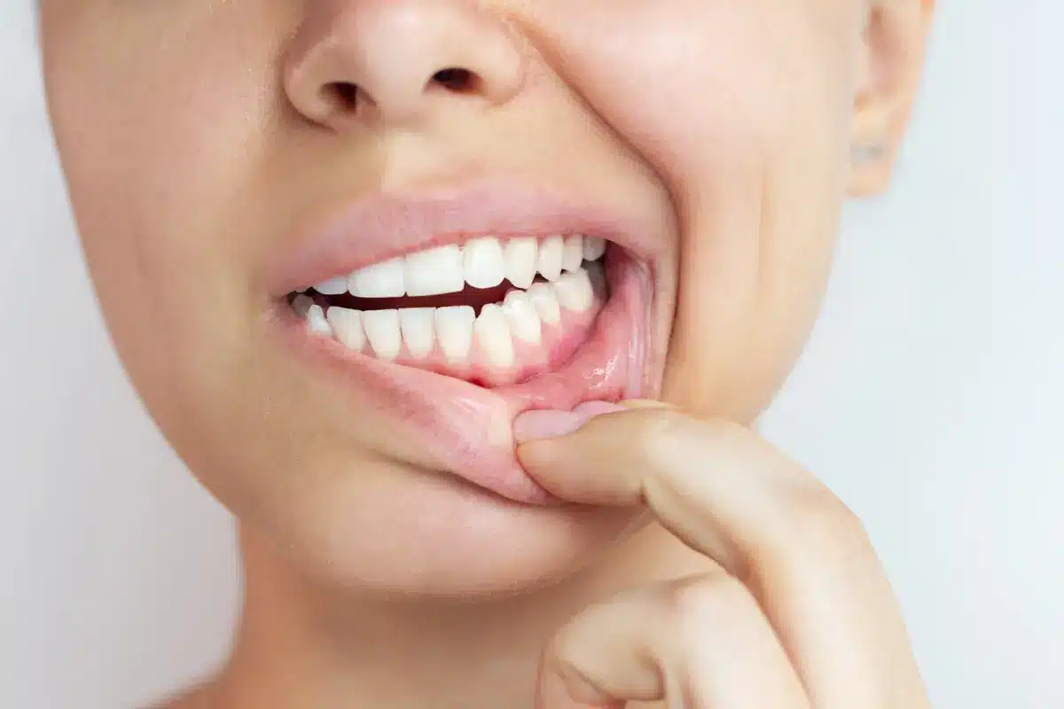Mujer revisando el estado de sus encías — cuándo acudir al dentista por periodontitis