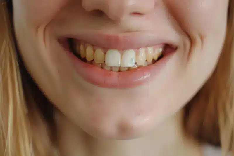 Dientes amarillos antes y después de un blanqueamiento dental profesional
