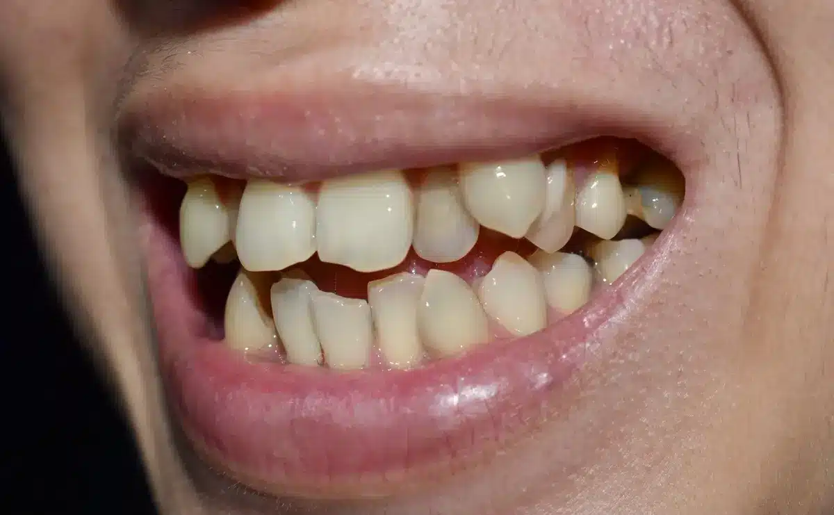Dientes apiñados — ejemplo de apiñamiento dental severo