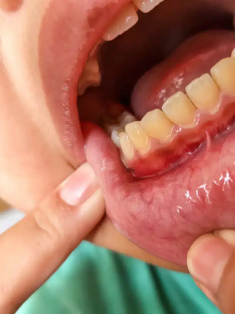 Encías inflamadas con sangrado, síntoma habitual de periodontitis y enfermedad periodontal