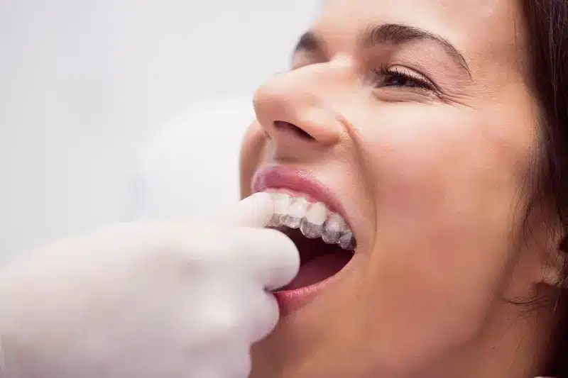 Ortodoncista colocando alineador invisible a paciente en Clínica DentoSmile