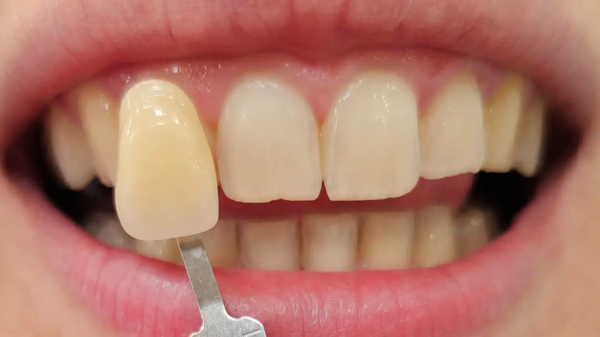 Antes del blanqueamiento dental