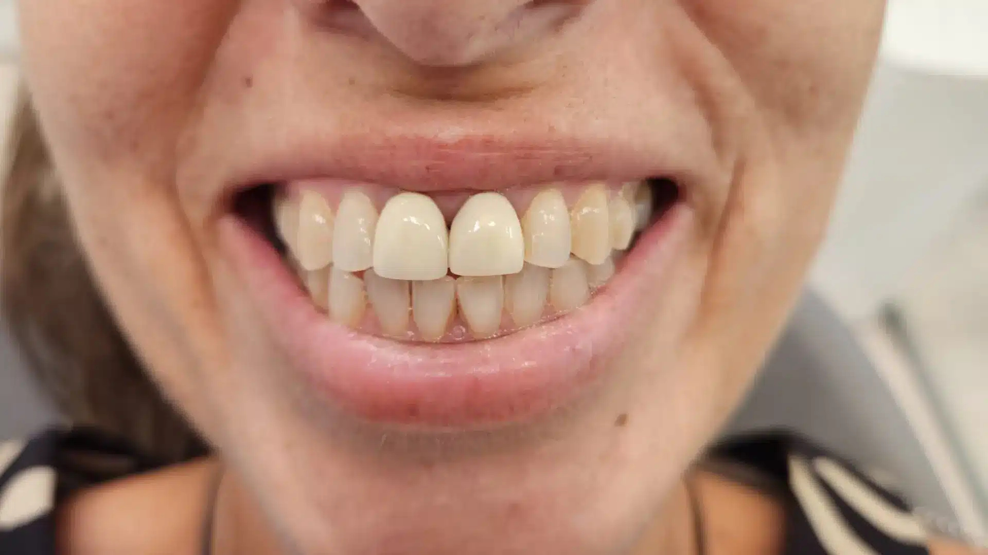 Antes del tratamiento de implantes dentales