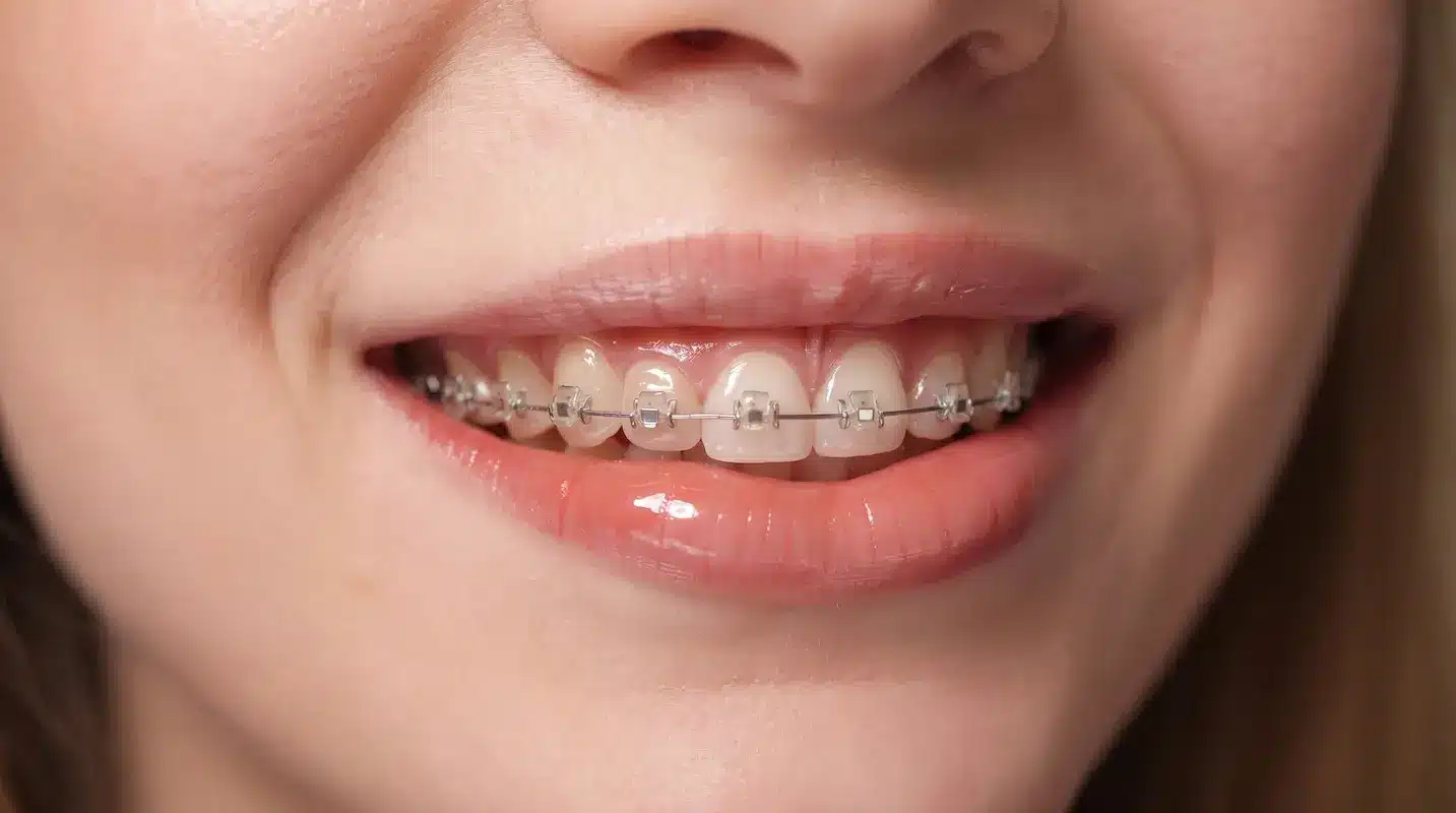 Brackets autoligables en DentoSmile