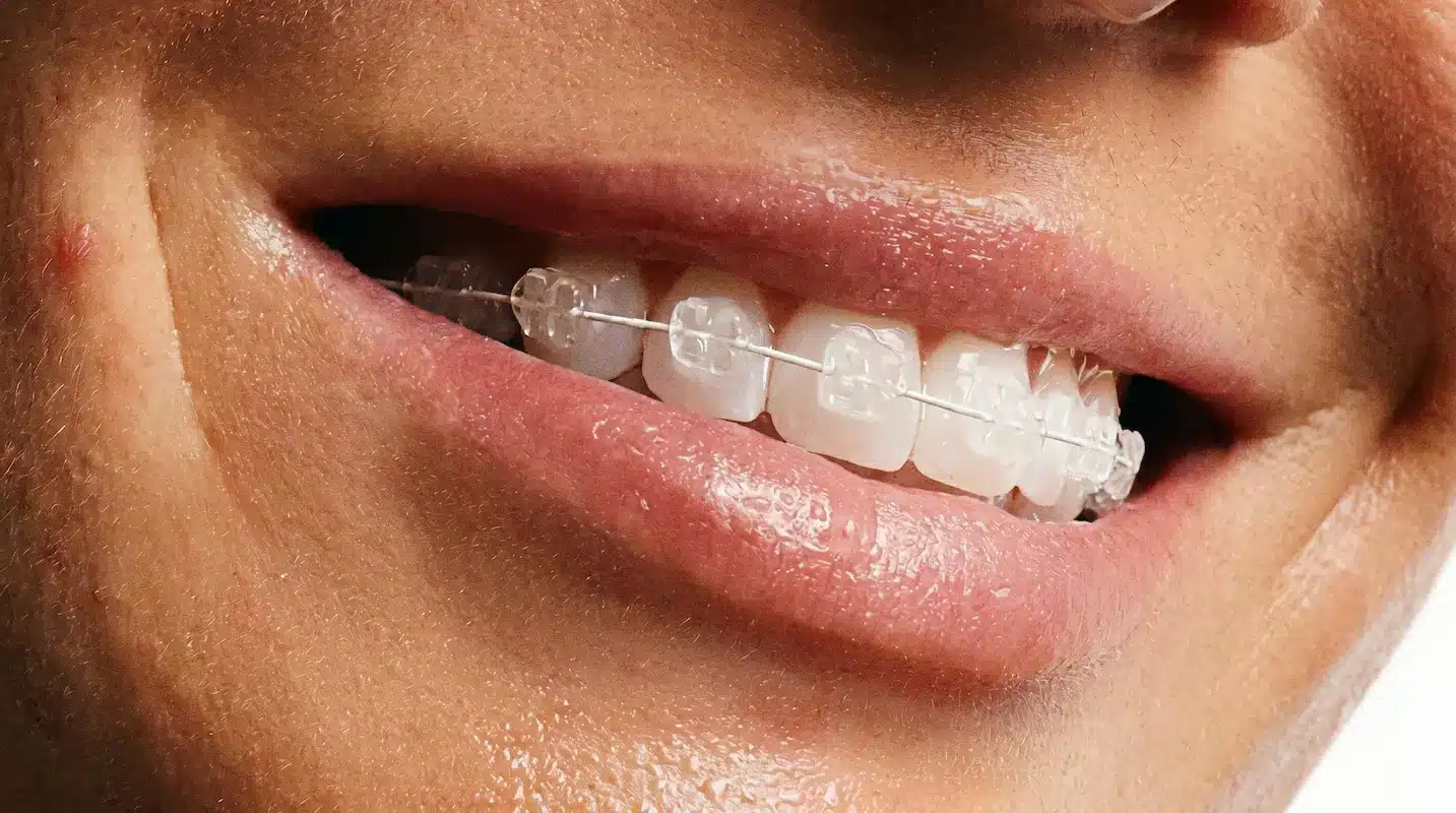 Brackets estéticos de zafiro en Alcalá de Henares