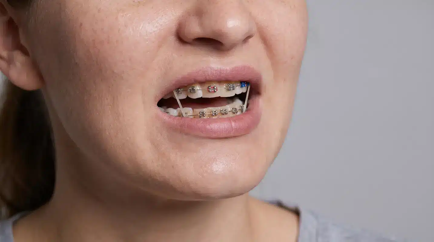 Brackets metálicos para ortodoncia