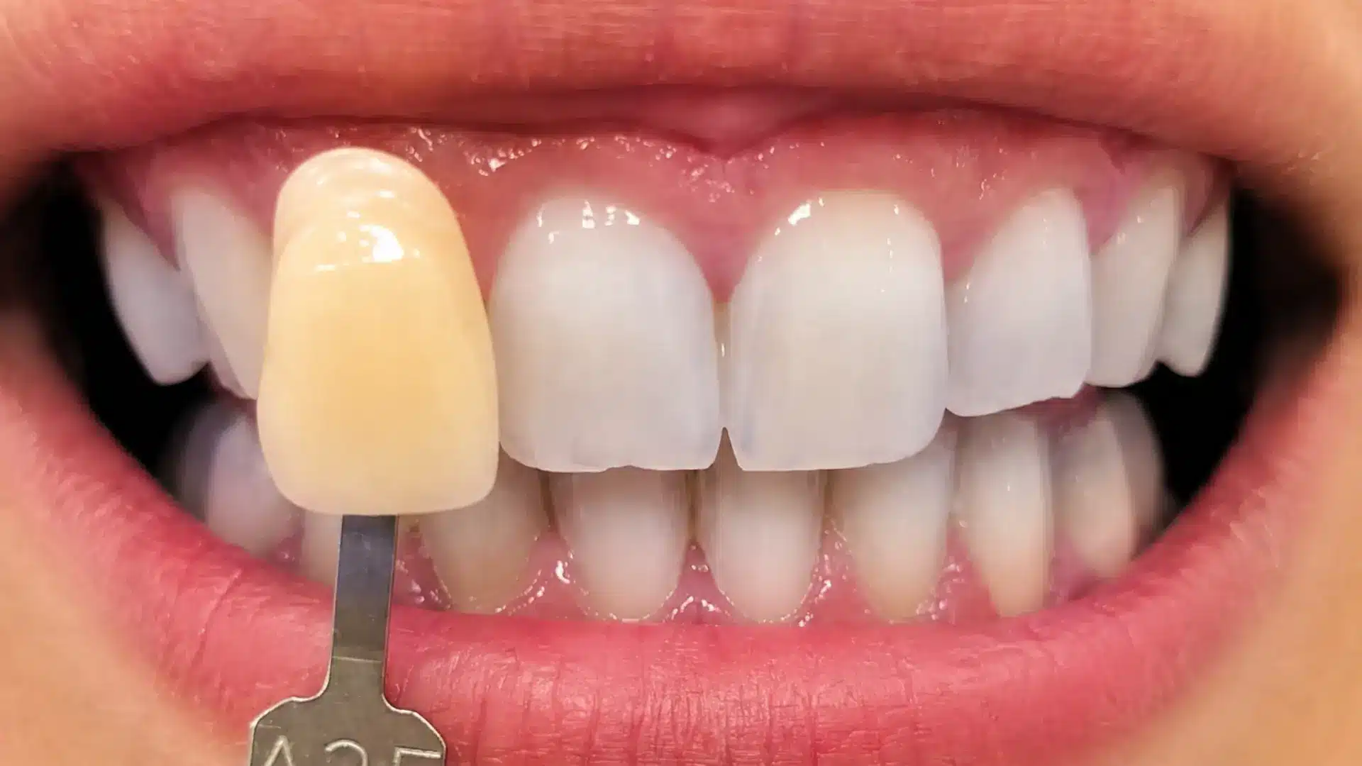 Después del blanqueamiento dental