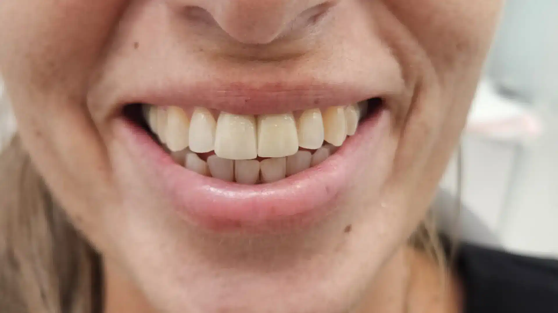 Después de implantes dentales con coronas de zirconio