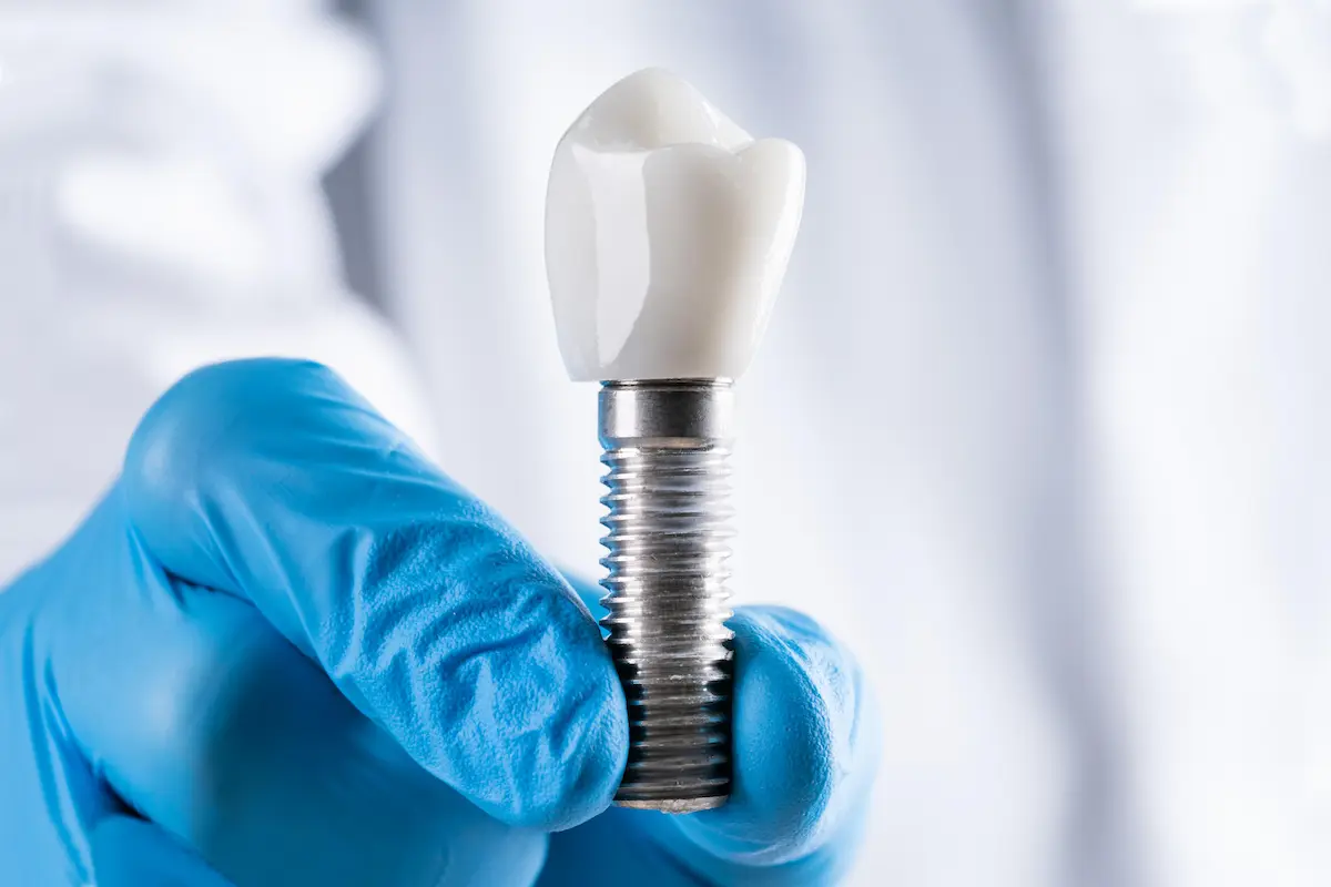 Implante dental unitario en Alcalá de Henares