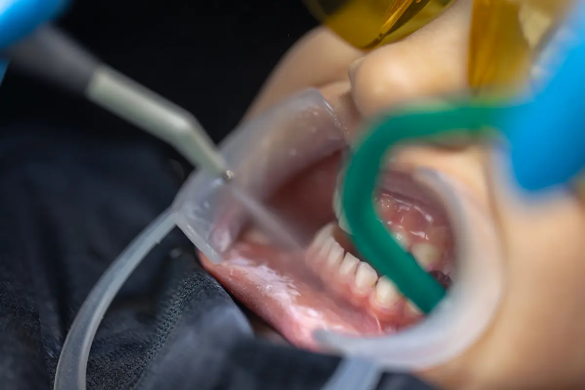 Tratamiento de limpieza dental profesional en Alcalá de Henares