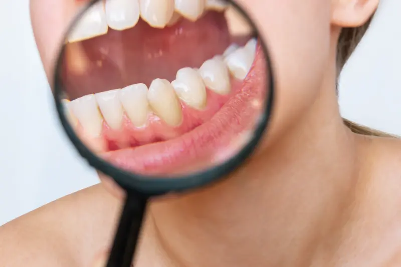 Acumulación de sarro dental visible con lupa para diagnóstico periodontal