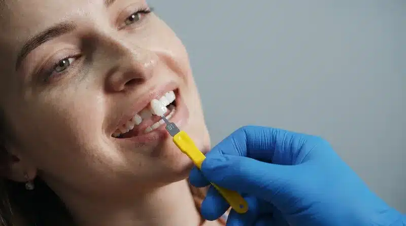 Carillas de porcelana dental