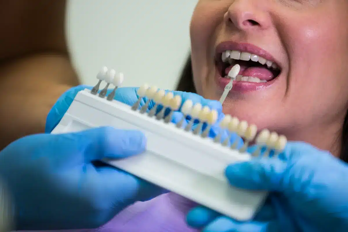 Proceso de blanqueamiento dental profesional en DentoSmile
