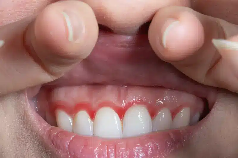 Encías rojas e inflamadas con signos de gingivitis y enfermedad periodontal
