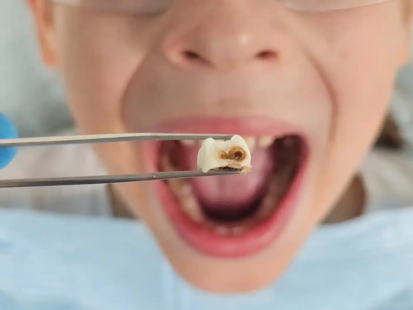 Odontopediatría en Alcalá de Henares para valorar caries infantil y problemas en dientes de leche