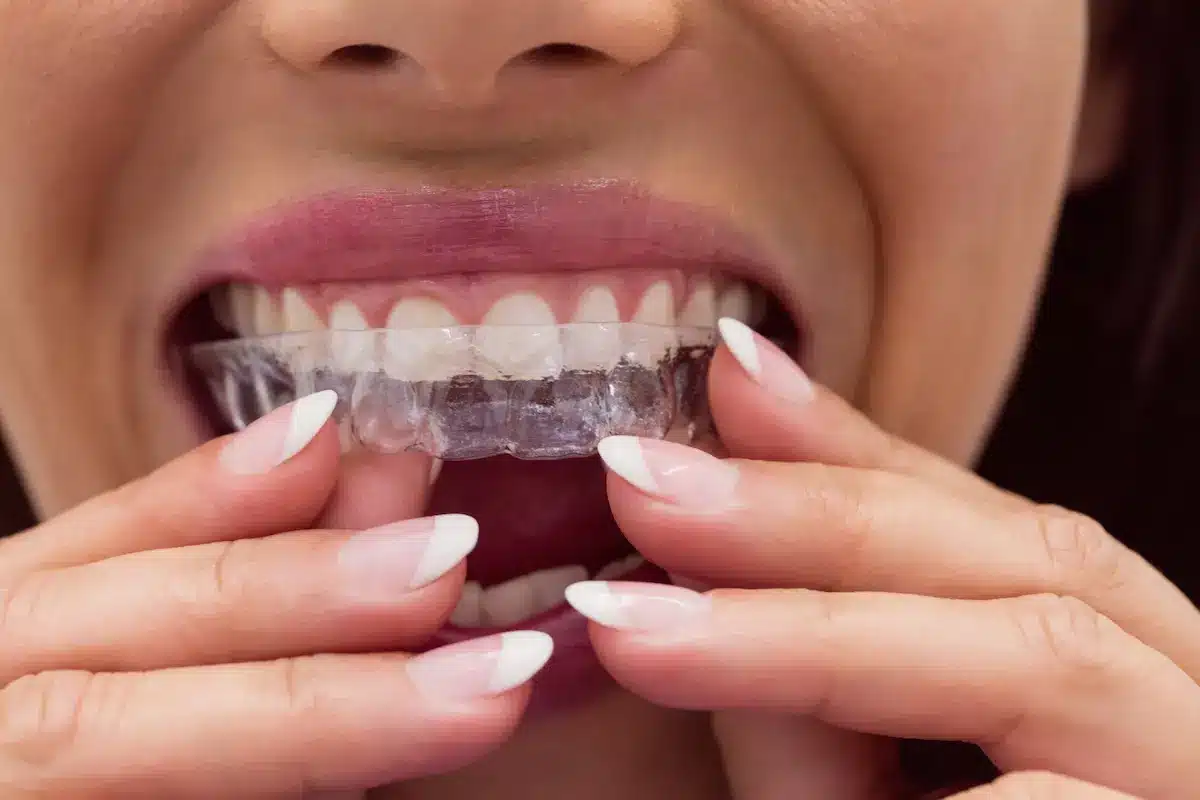 Ortodoncia invisible Invisalign en Alcalá de Henares