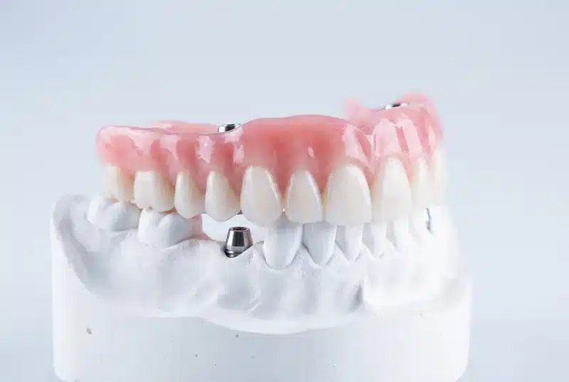 Prótesis dental completa sobre implantes en un modelo de escayola